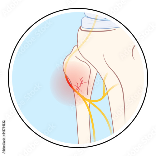 common tibial fibular pain with ankle trauma lower leg atrophy muscle lift loss knee sciatic nerve injury of feet drop palsy and spinal cord test spine damage brain Stroke flex deep Neck bone cervical