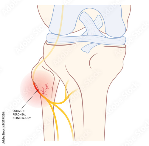 lower leg atrophy with muscle lift loss knee sciatic nerve injury of feet drop palsy and spinal cord test ankle trauma tibial fibular pain spine damage brain Stroke flex deep Neck bone common cervical