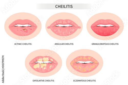 Types of dry lip fungal oral cold sore skin pain tongue Licker's Glandular chapping vermilion border swollen Crusty Itchy diaper rash bacteria Cracking ulcer cancer Syphilis thrush virus lupus fever