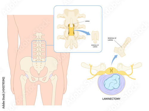 lumbar laminectomy spine cord surgery of root back pain disc tumor cancer cyst bone spurs vertebrae Muscle weakness diskectomy transforaminal compressed nerve Anterior fusion replacement annular tear