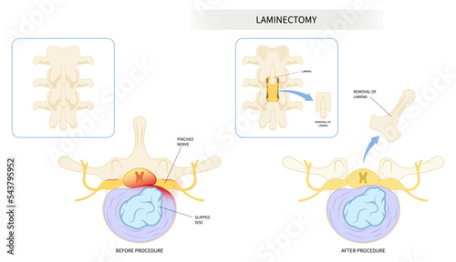 compressed back nerve lumbar of annular tear laminectomy spine cord surgery root muscle pain disc tumor cancer cyst bone spurs vertebrae weakness diskectomy anterior fusion transforaminal replacement photo