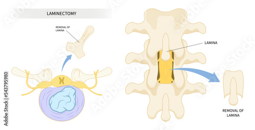 compressed back nerve lumbar of annular tear laminectomy spine cord surgery root muscle pain disc tumor cancer cyst bone spurs vertebrae weakness diskectomy anterior fusion transforaminal 
replacement