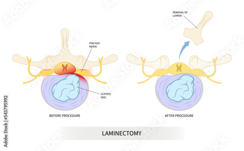 vertebrae back pain lumbar of diskectomy laminectomy spine cord surgery root disc tumor cancer cyst bone spurs Muscle weakness transforaminal compressed annular tear nerve Anterior fusion replacement