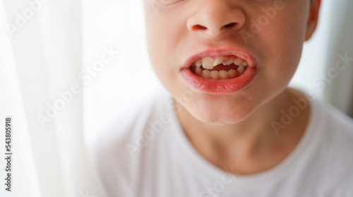 Child Open Bite or Maloccusion due to thumb sucking. Close up of youngster face with crooked teeth before install braces photo
