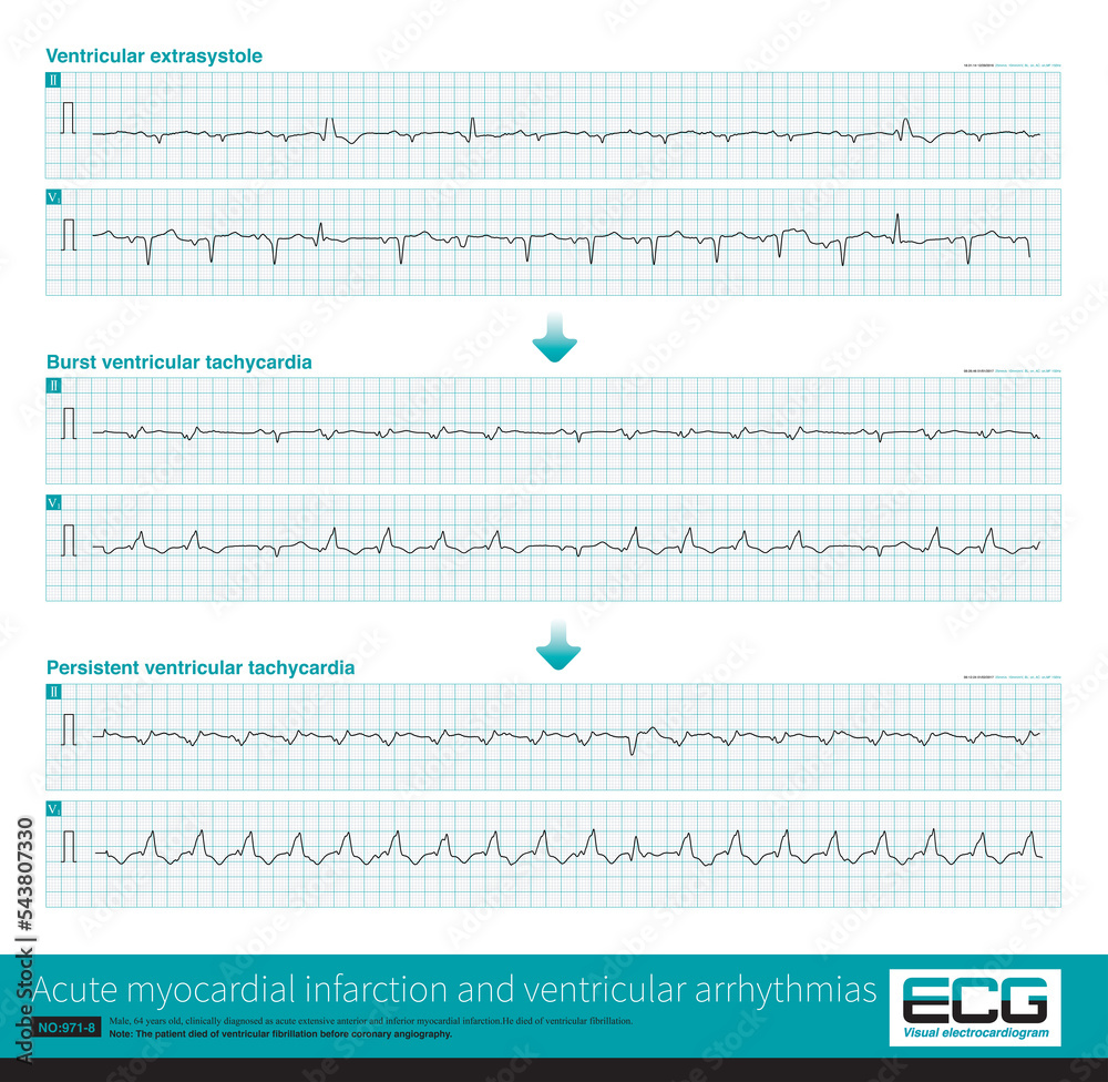 A patient with acute extensive anterior myocardial infarction developed ...