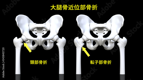 大腿骨近位部骨折（骨盤あり） photo