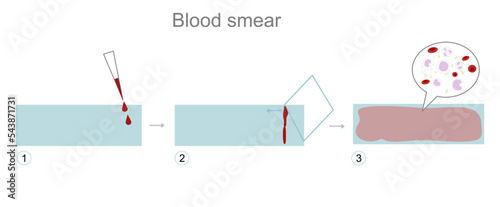 The step of blood smear or film of blood cell observation on glass slide photo