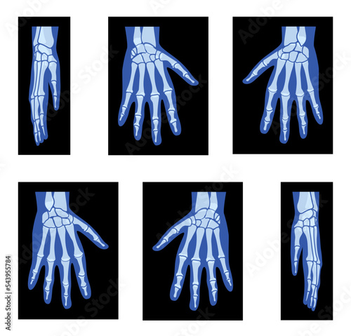 Set of X-Ray Hands Skeleton Human body, Bones adult people roentgen front back side view. 3D realistic flat blue color concept Vector illustration of medical anatomy isolated on black background