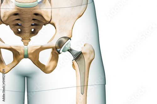 Hip prosthesis or implant isolated on white background with copy space and body contours. Hip joint or femoral head replacement 3D rendering illustration. Medicine, surgery, science concepts. photo