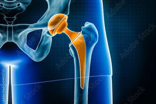 Hip prosthesis x-ray 3D rendering illustration. Total hip joint replacement surgery or arthroplasty, medical and healthcare, arthritis, pathology, science, osteology, orthopedics concepts. photo