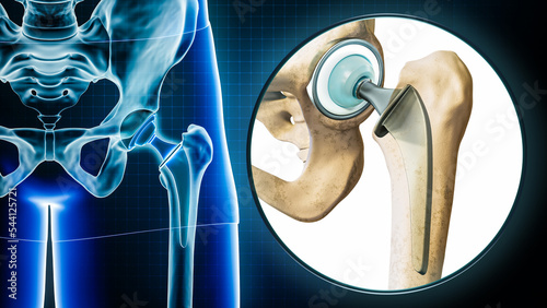 Femoral head hip prosthesis or implant x-ray with magnification or close-up. Total hip joint replacement surgery or arthroplasty 3D rendering illustration. Medical and healthcare, science concepts.