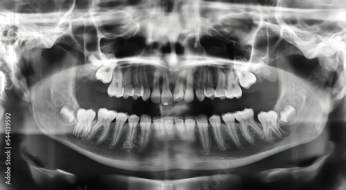 Panoramic radiography (orthopantomography) by means of X-rays showing the dental structure and oral anatomy of a twelve-year-old girl to analyze any oral complications in the field of dentistry
