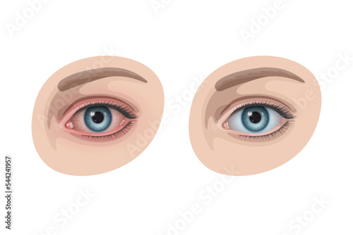 Reddened unhealthy human eye with many blood vessels and healthy eye