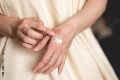 Itching on hands with redness rash. Cause of itchy skin include dermatitis (eczema), dry skin, burned, food,drug allergies, insect bites. Health care concept. photo