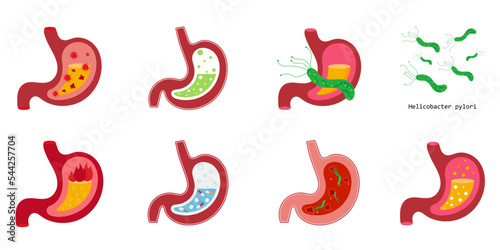 Vector Collection of illustrations human anatomy, stomach with pills, with heartburn, gases, helicobacter pylori, stomach ulcer. photo