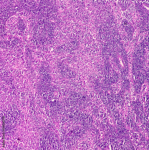 Caecum lymph node biopsy: Chronic nonspecific lymphadenitis. Photomicrograph show lymph node, features of reactive change. photo