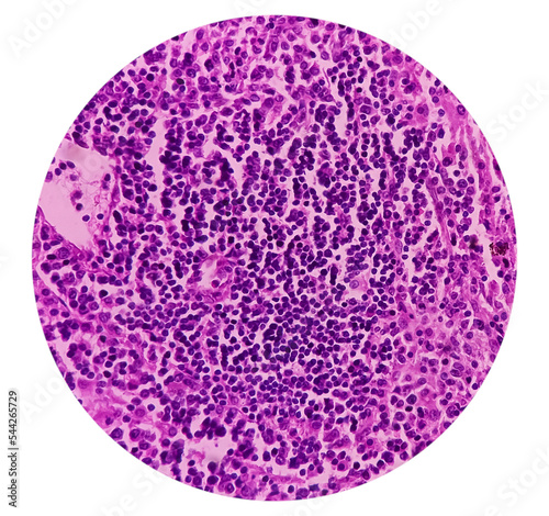 Caecum lymph node biopsy: Chronic nonspecific lymphadenitis. Photomicrograph show lymph node, features of reactive change. photo