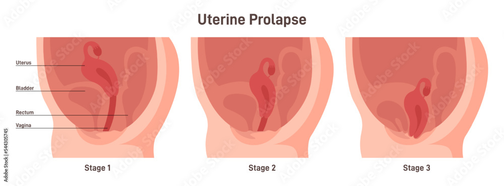 Stages of uterine prolapse. Pelvic floor muscles weakening