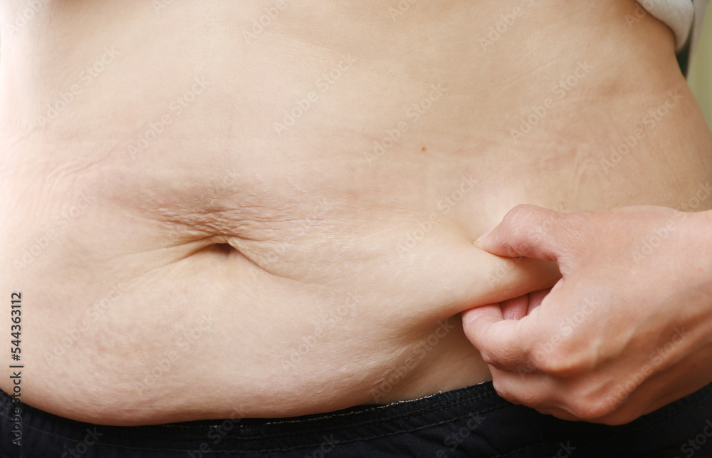 Close up of mother womans belly showing stretch mark loose lower abdomen skin she fat after pregnancy baby birth, studio isolated on white background, Healthy belly overweight excess body concept Close up of mother womans belly showing stretch mark loose lower abdomen skin she fat after pregnancy baby birth, studio isolated on white background, Healthy belly overweight excess body concept