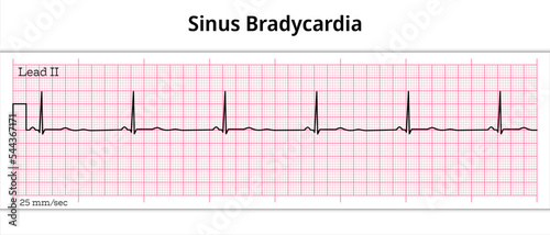 ECG Sinus Bradycardia - 8 Second ECG Paper