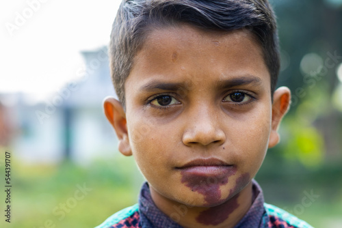 Melanoma dark skin birthmark on face of young Asian boy photo