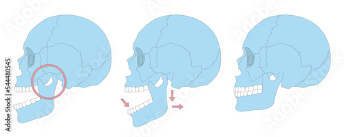 dislocation skull vector illustration photo