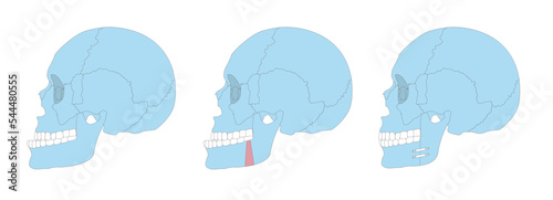 Orthognathic surgery vector illustration overbite teeth dental