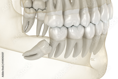 Mesial impaction of Wisdom teeth. Medically accurate tooth 3D illustration photo