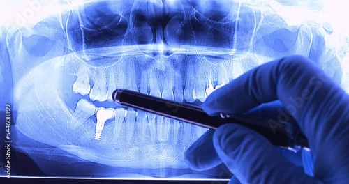 Doctor analyzing dental x-ray with implants. Radiography for dental structures research concept. Dolly shot 4k
