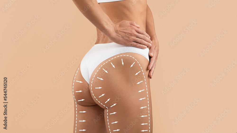 Anti-Cellulite Treatment. Perfect Female Buttocks With Drawn Lifting Up Lines And Arrows - obrazy, fototapety, plakaty 