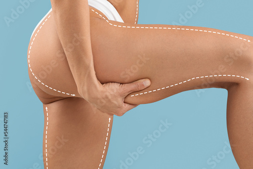 Cellulite Reduction. Slim Female With Drawn Lines On Body Pulling Thigh Skin