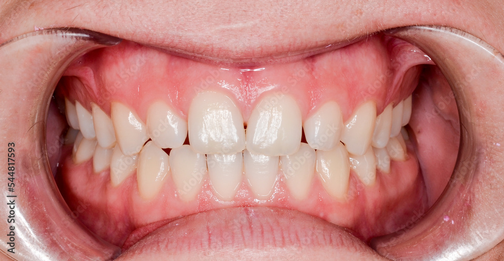 Fototapeta premium gesundes gebiss, frontalansicht