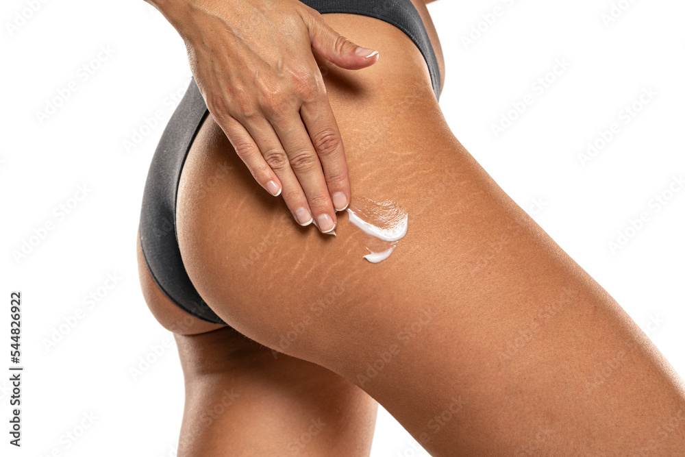 woman applying stretch marks lotion on her hips