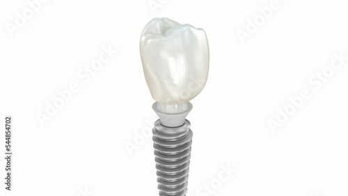 Ceramic crown, custom implant abutment and implantat instalation process. Medically accurate 3D animation