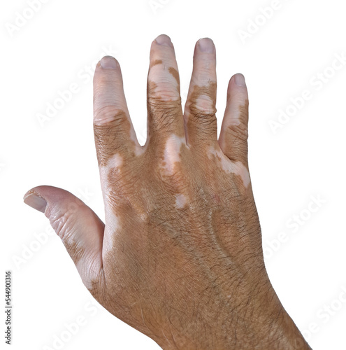Hand with vitiligo on transparent isolated png background