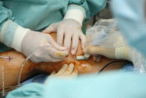 Preparing the patient for phlebectomy surgery. Surgical field marking. Varicose veins surgery act, superficial veins problems, swollen skin, step by step 