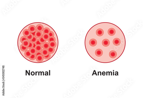 Scientific Designing of Anemia Symptoms. Normal and Anemia Blood Comparison. Colorful Symbols. Vector Illustration. photo