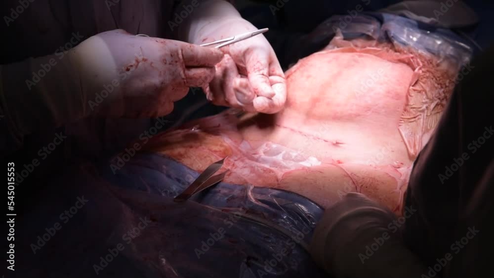 last stitch of scar after surgery in the cesarean section operating room
