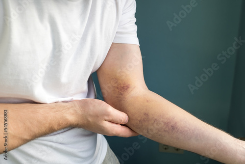 Large bruise on arm. Hand injury. Close-up. © koldunova
