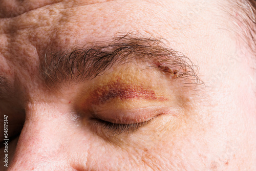 close view of a bruise near the eye, the face of a man with a hematoma