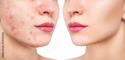 Young woman before and after acne treatment.