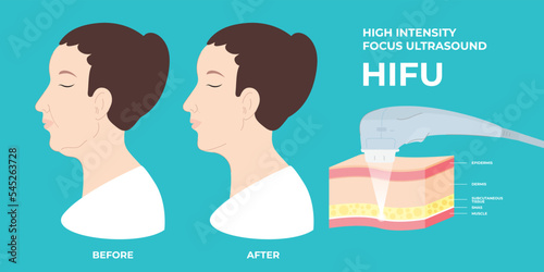 HIFU spa treatment before and after. High intensity focus ultrasound. SMAS ultrasound face lifting massage with hardware. Skin treat. Face saggy skin treat. Cell body lift. Double chin lift photo