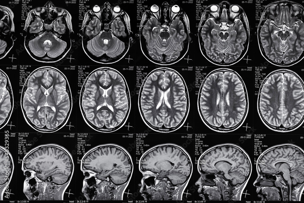 High resolution resonance image scan of brain epi syndrome