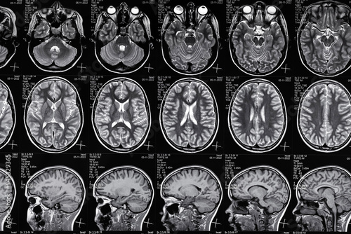 High resolution magnetic resonance image scan of brain epi syndrome. Real MRI scan of head, close up.