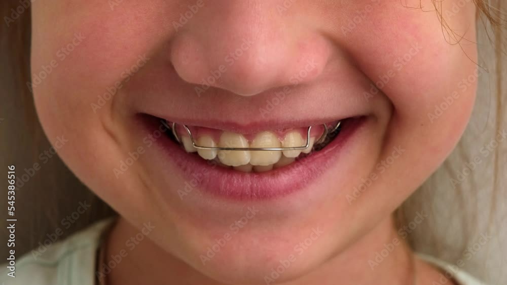 Child girl mouth with orthodontic plate close up. Removable plates and simple treatment. Teeth alignment, retainer orthodontic correction Child girl mouth with orthodontic plate close up. Removable plates and simple treatment. Teeth alignment, retainer orthodontic correction