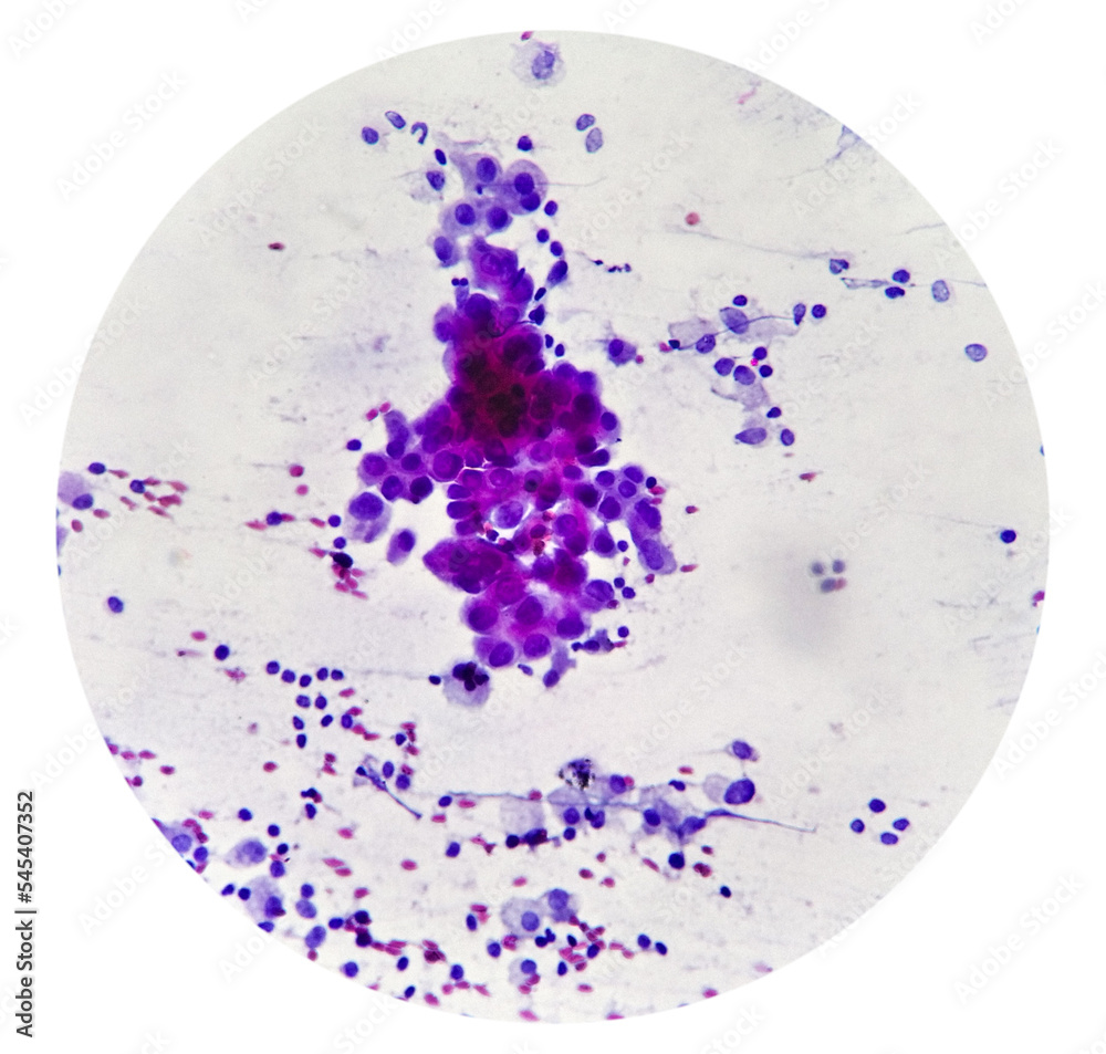 Intra abdominal mass(Cytology) Spindle cell positive