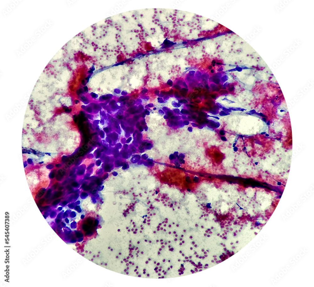 Intra abdominal mass(Cytology) Spindle cell positive