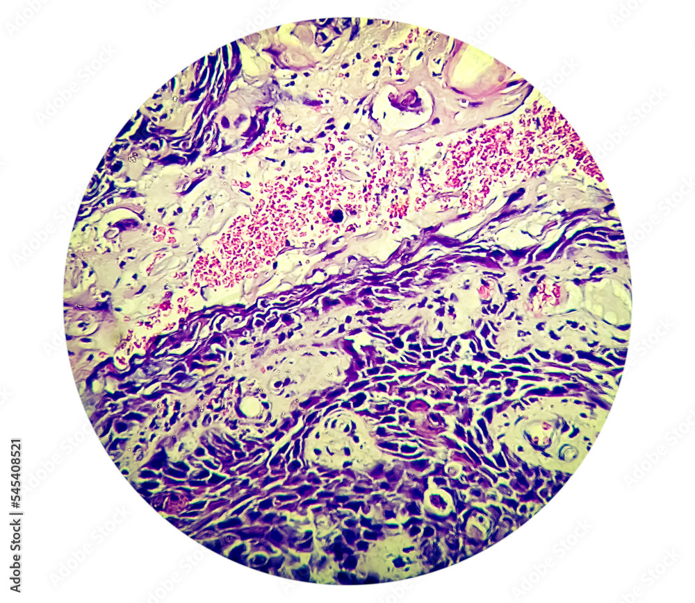 Squamous papilloma of lamber spine area to the human papilloma virus ...