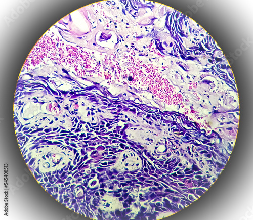 Squamous papilloma of lamber spine area to the human papilloma virus (HPV), Squamous cell papilloma, benign growth