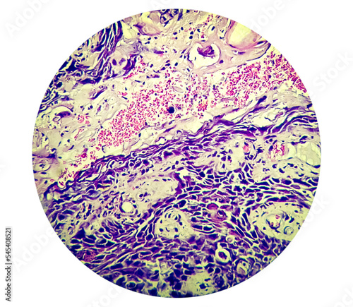 Squamous papilloma of lamber spine area to the human papilloma virus (HPV), Squamous cell papilloma, benign growth photo